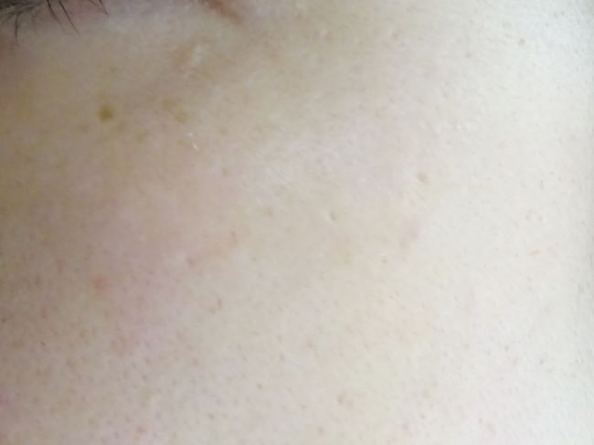 美容レーザー治療（マトリックスIR＋フォトRF）10日後の経過
